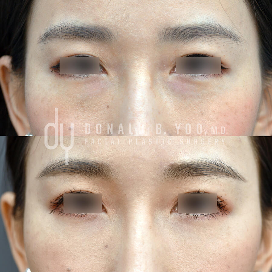 SURGICAL :: BLEPHAROPLASTY<br>Lower Blepharoplasty with Fat Repositioning