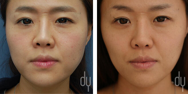 NONSURGICAL :: BOTOX<br>V-line Masseter Reduction