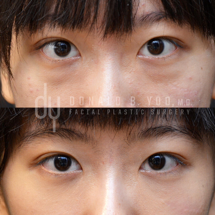 SURGICAL :: BLEPHAROPLASTY<br>Lower Blepharoplasty with Fat Repositioning