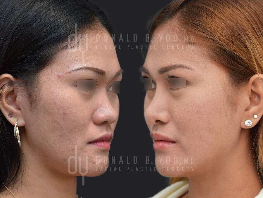 SURGICAL :: RHINOPLASTY<br>Asian Rhinoplasty with Rib Cartilage and DCF