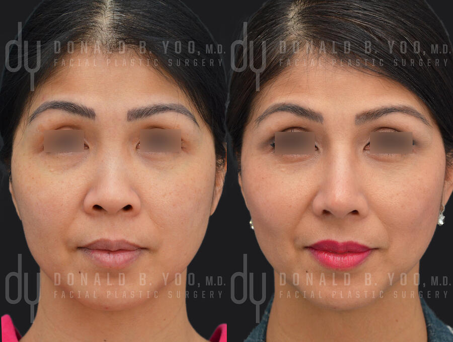 SURGICAL :: RHINOPLASTY<br>Asian Rhinoplasty with Rib Cartilage and DCF