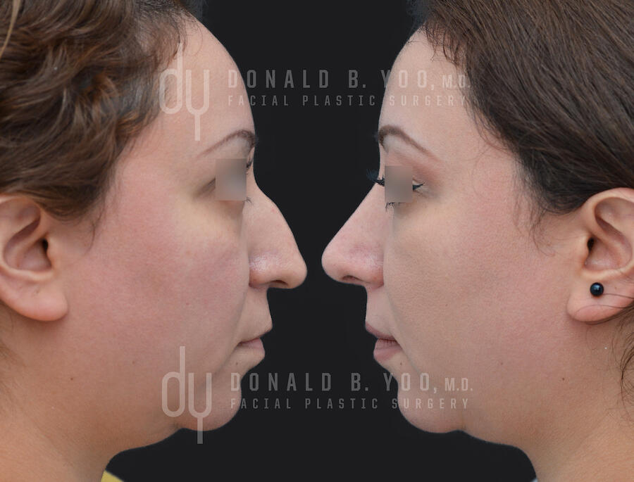 SURGICAL :: RHINOPLASTY<br>Primary Rhinoplasty and Septoplasty