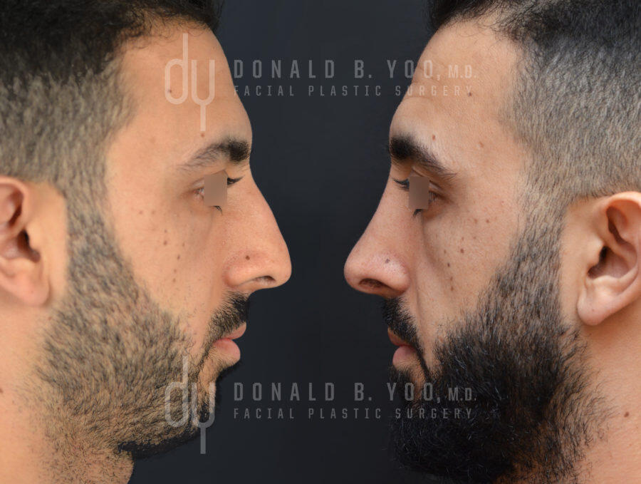 SURGICAL :: RHINOPLASTY<br>Primary Rhinoplasty and Septoplasty