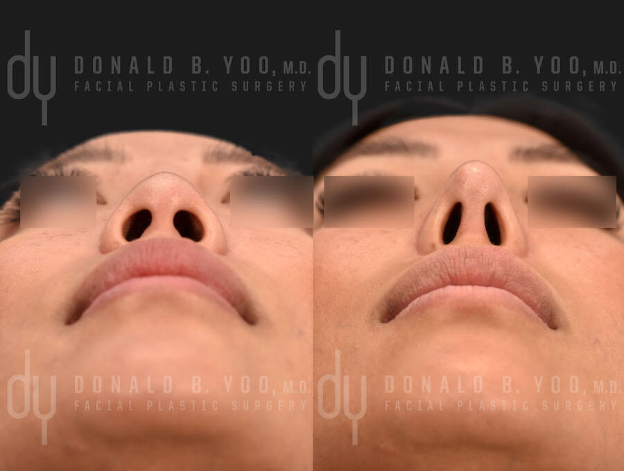 SURGICAL :: RHINOPLASTY<br>Alar Base Modification