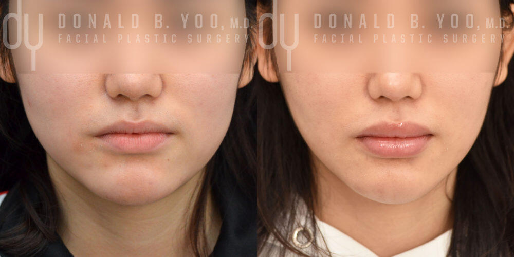 SURGICAL :: BUCCAL FAT REMOVAL<br>Buccal fat removal