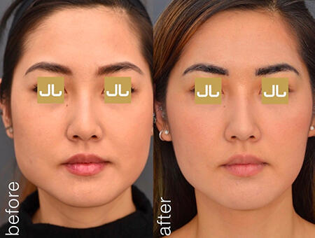 NONSURGICAL :: BOTOX<br>Masseter Reduction