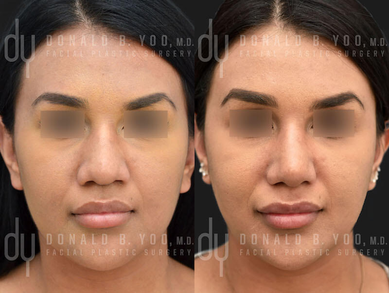 SURGICAL :: RHINOPLASTY<br>Primary Rhinoplasty