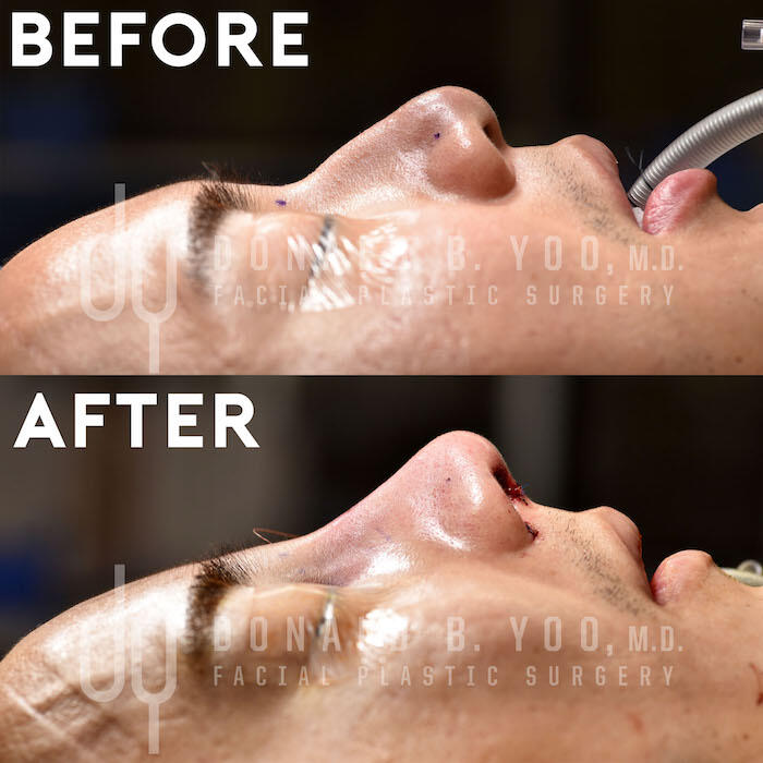 SURGICAL :: RHINOPLASTY<br>Asian Rhinoplasty with Rib Cartilage and DCF