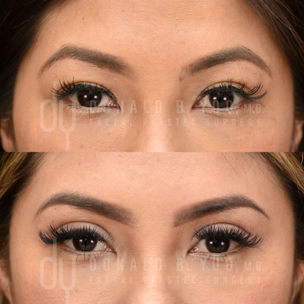 SURGICAL :: BLEPHAROPLASTY<br>Upper Blepharoplasty