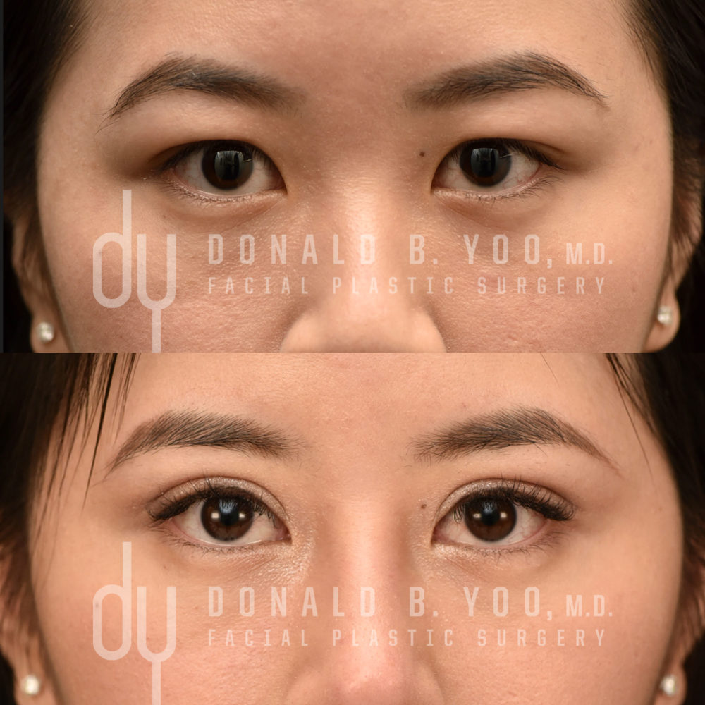 SURGICAL :: BLEPHAROPLASTY<br>Upper Blepharoplasty | Asian Double Eyelid