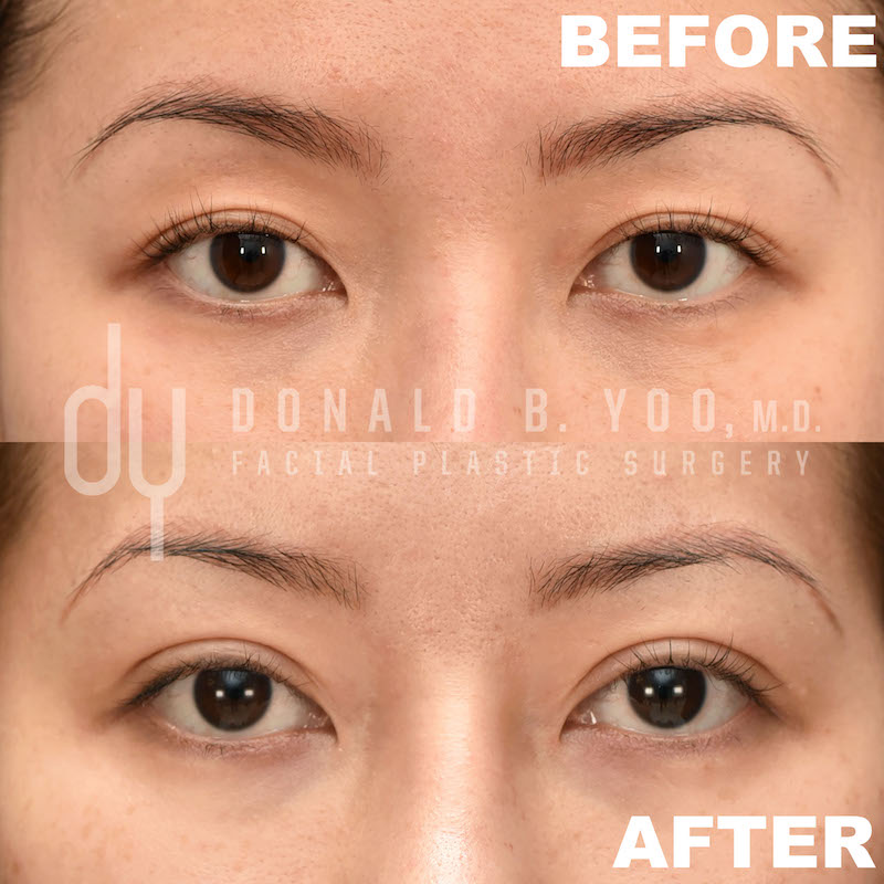 SURGICAL :: BLEPHAROPLASTY<br>Upper Blepharoplasty | Asian Double Eyelid