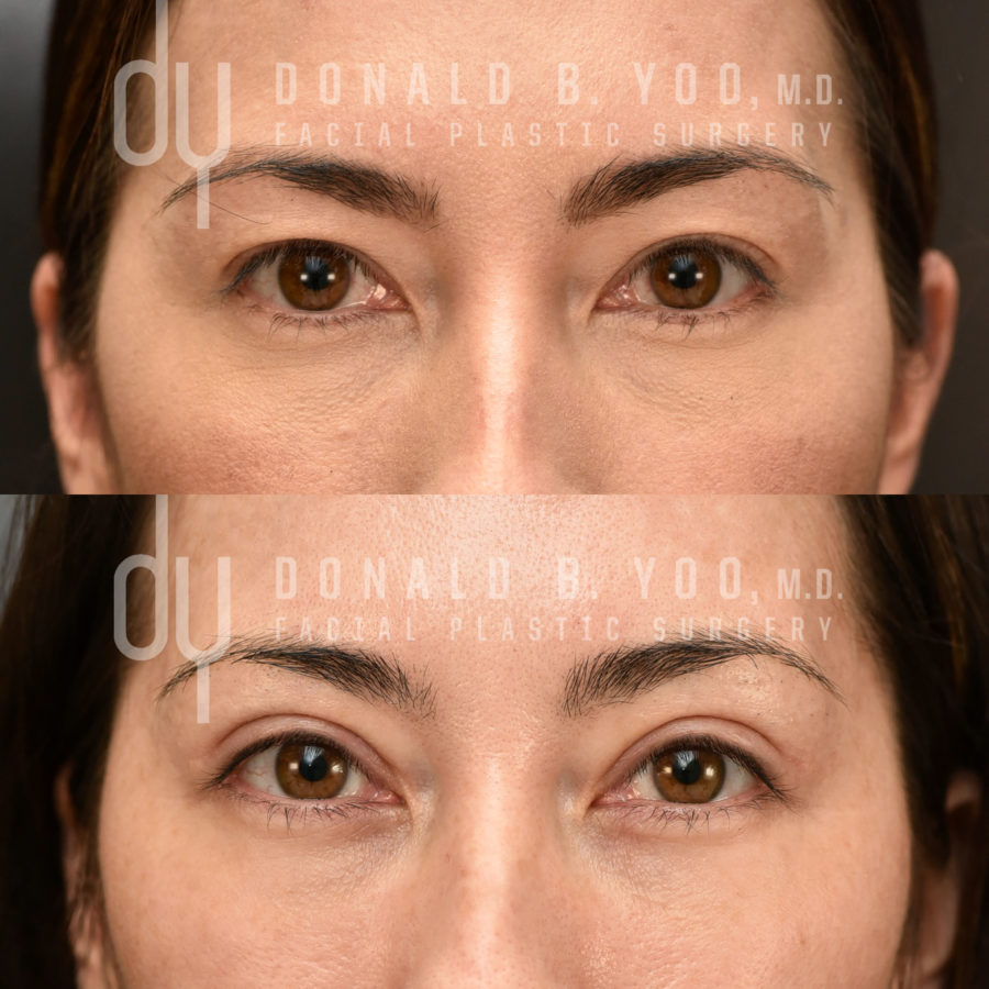 SURGICAL :: BLEPHAROPLASTY<br>Upper Blepharoplasty