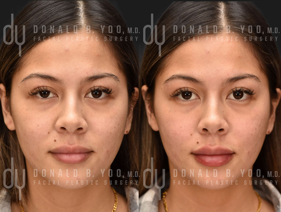NONSURGICAL :: FILLERS <br> Lip Augmentation