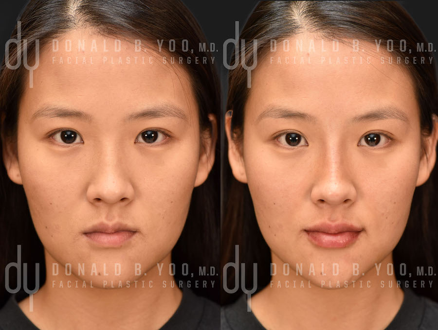 NONSURGICAL :: FILLERS <br> Lip Augmentation and Nonsurgical Rhinoplasty