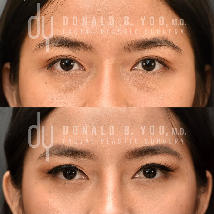 SURGICAL :: BLEPHAROPLASTY<br>Lower Blepharoplasty with Fat Repositioning