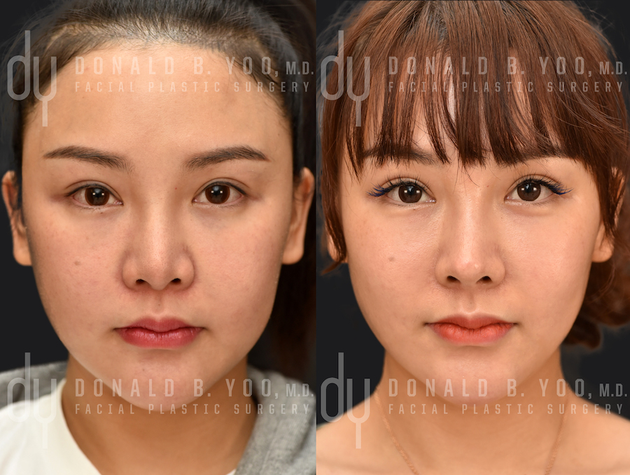 SURGICAL :: RHINOPLASTY<br>Revision Asian Rhinoplasty with Rib Cartilage and DCF