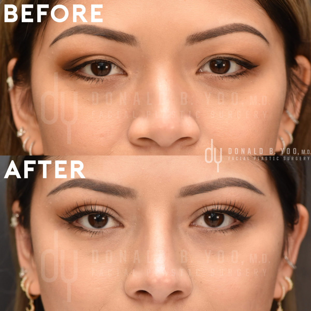 SURGICAL :: BLEPHAROPLASTY<br>Upper Blepharoplasty