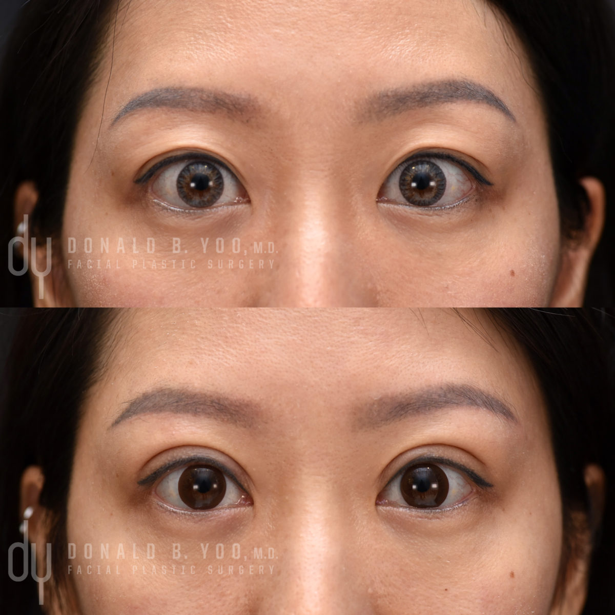 SURGICAL :: BLEPHAROPLASTY<br>Upper Blepharoplasty