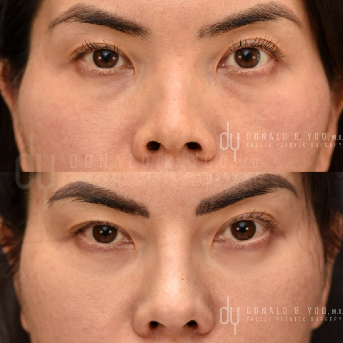 SURGICAL :: BLEPHAROPLASTY<br>Lower Blepharoplasty with Fat Repositioning