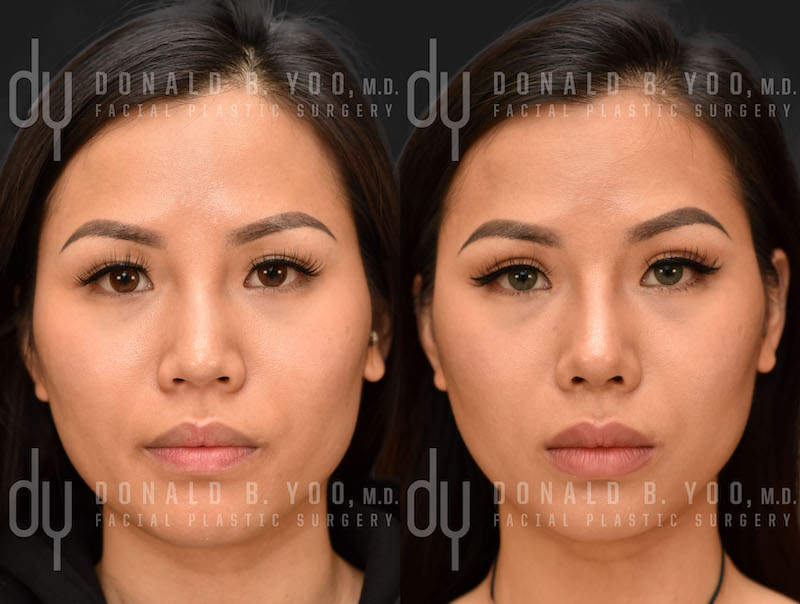 SURGICAL :: RHINOPLASTY<br>Asian Rhinoplasty with Rib Cartilage and DCF