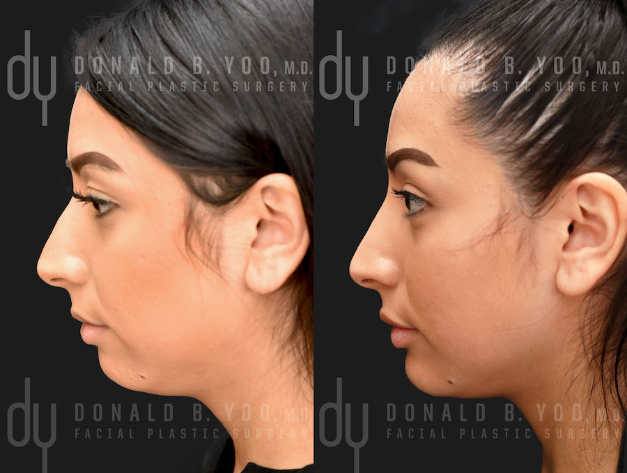 NONSURGICAL :: FILLERS <br> Nonsurgical Rhinoplasty and Chin Augmentation