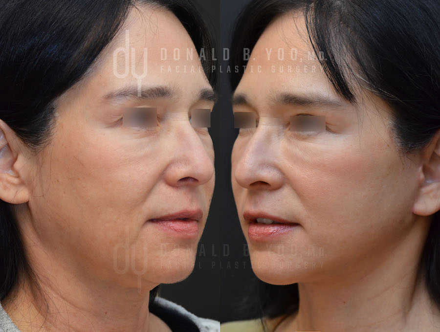 SURGICAL :: FACELIFT<br>Deep Plane Facelift