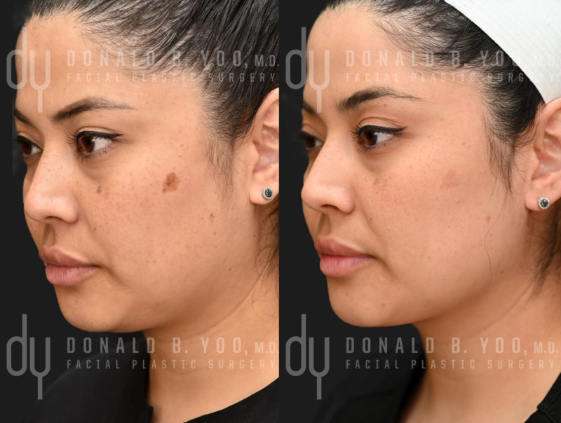 NONSURGICAL :: PICOSURE<br>Picosure for sun spots and melasma