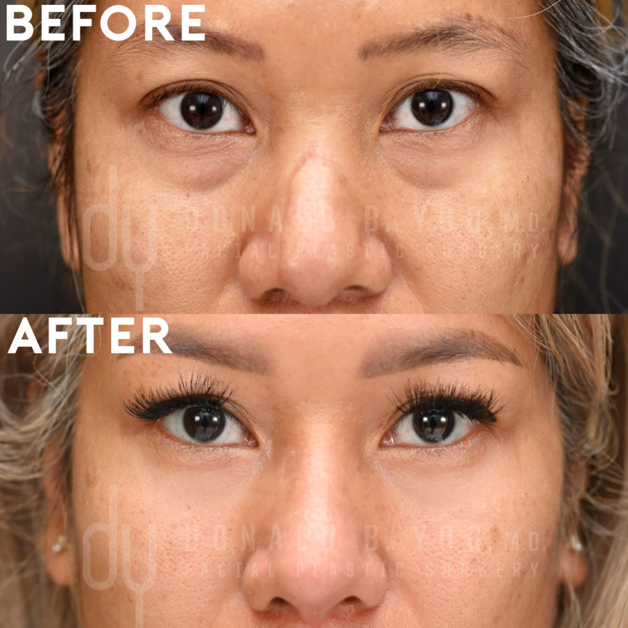 SURGICAL :: BLEPHAROPLASTY<br>Lower Blepharoplasty with Fat Repositioning