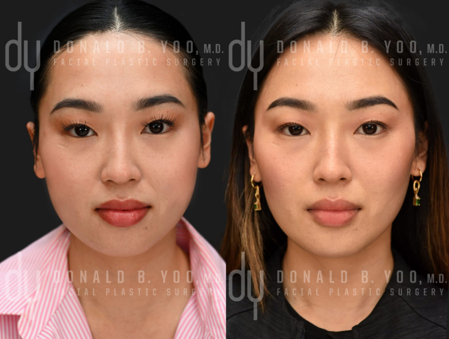 NONSURGICAL :: BOTOX<br>V-line Masseter Reduction