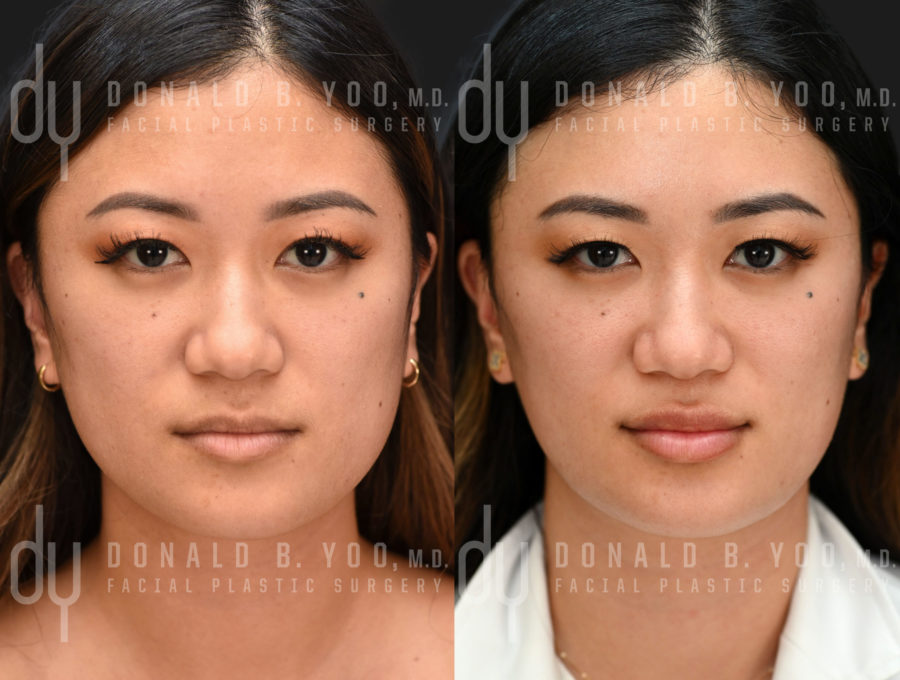 NONSURGICAL :: BOTOX<br>V-line Masseter Reduction