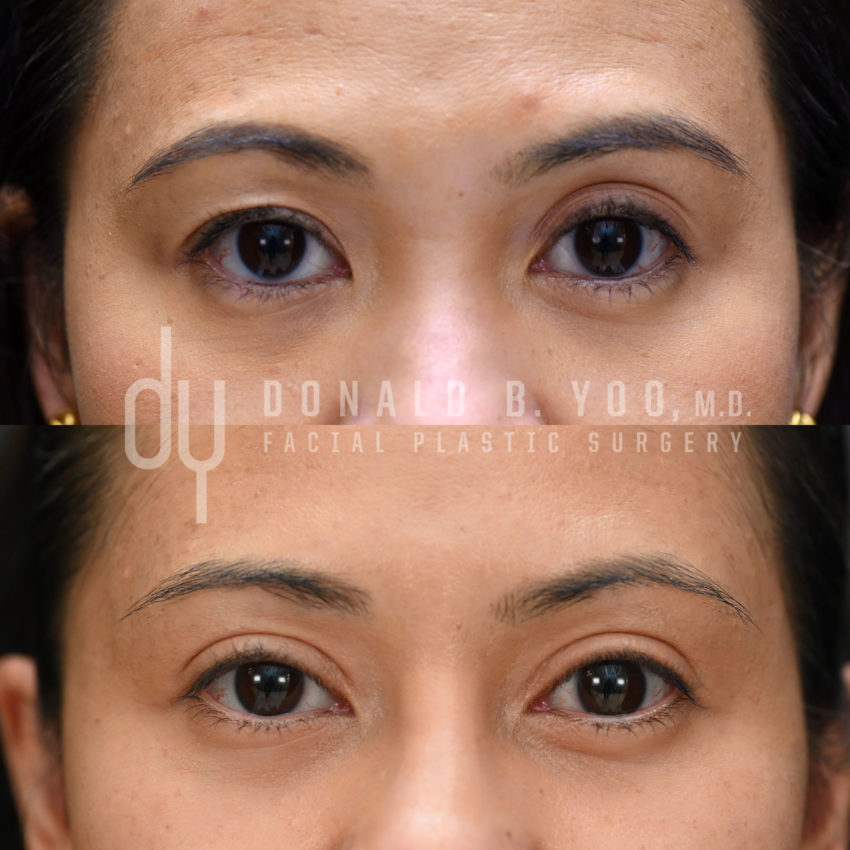 SURGICAL :: BLEPHAROPLASTY<br>Upper Blepharoplasty