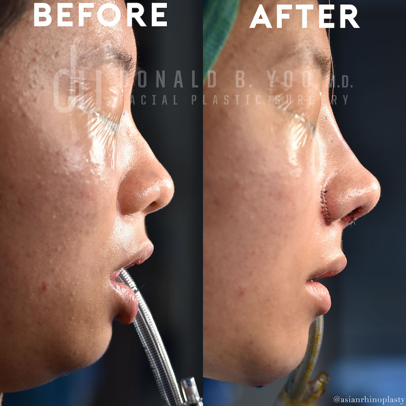 SURGICAL :: RHINOPLASTY<br>Asian Rhinoplasty with Rib Cartilage and DCF