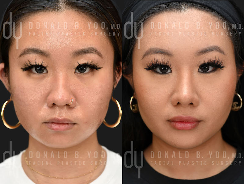 SURGICAL :: RHINOPLASTY<br>Asian Rhinoplasty with Alar base modification