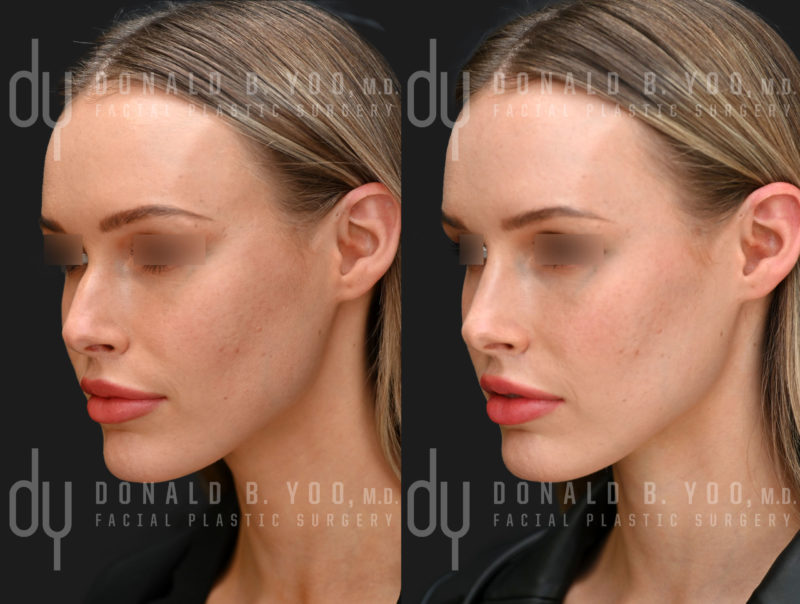 NONSURGICAL :: FILLERS<br>Nonsurgical Rhinoplasty