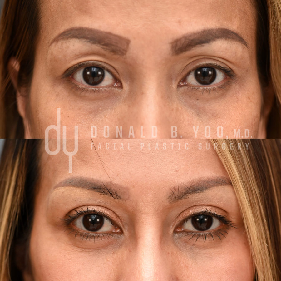 SURGICAL :: BLEPHAROPLASTY<br>Upper Blepharoplasty