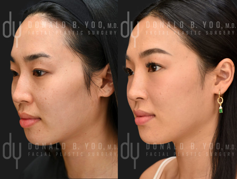 NONSURGICAL :: FILLERS<br>Nonsurgical Rhinoplasty