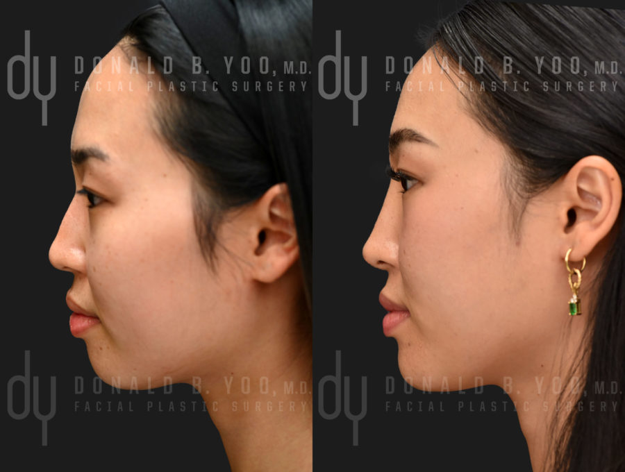 NONSURGICAL :: FILLERS <br> Nonsurgical Rhinoplasty and Chin augmentation