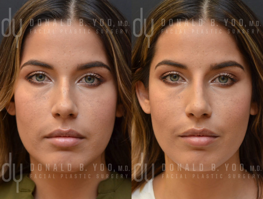 NONSURGICAL :: FILLERS <br> Nonsurgical Rhinoplasty 