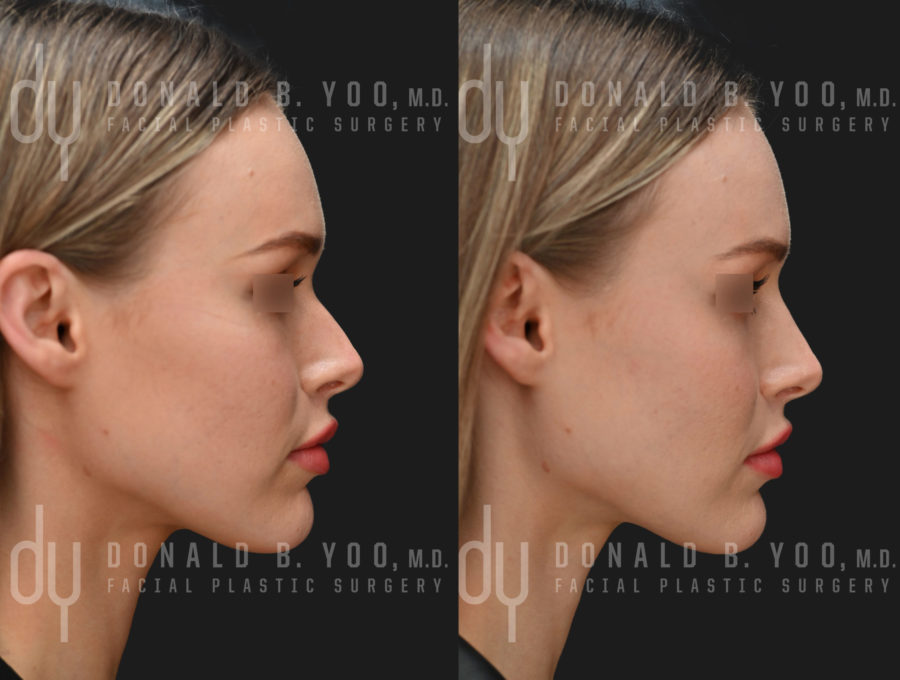 NONSURGICAL :: FILLERS <br> Nonsurgical Rhinoplasty 