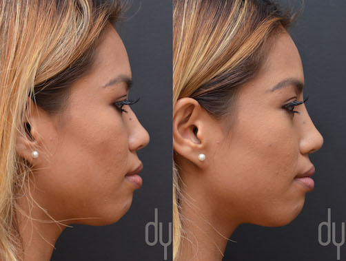 NONSURGICAL :: FILLERS <br> Nonsurgical Rhinoplasty 