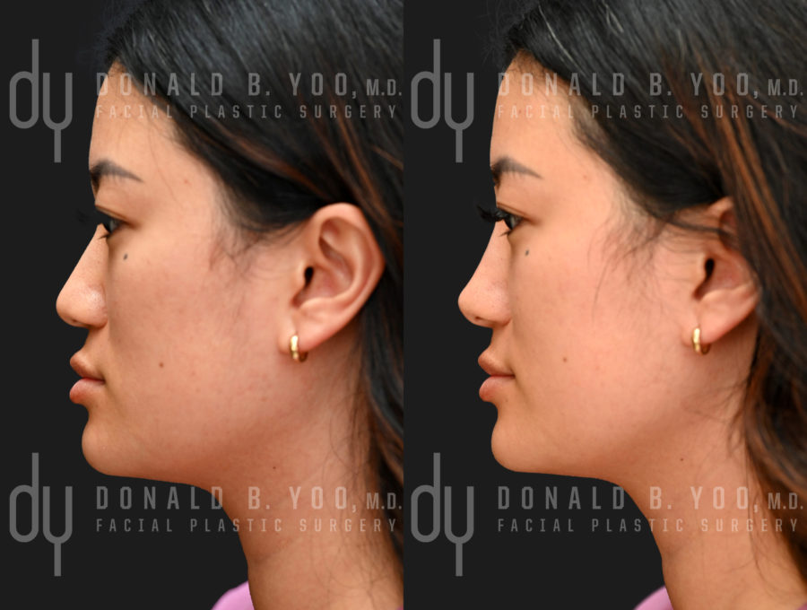 NONSURGICAL :: FILLERS<br>Nonsurgical Rhinoplasty