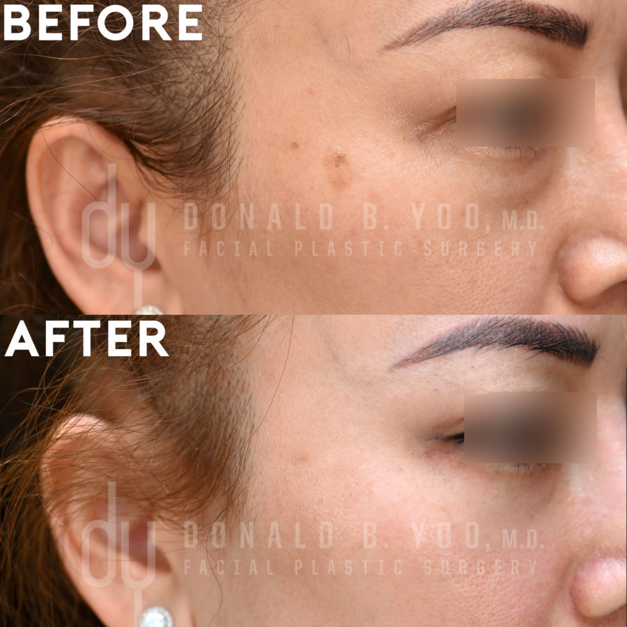 NONSURGICAL :: PICOSURE<br>Picosure for sun spots and hyper pigmentation