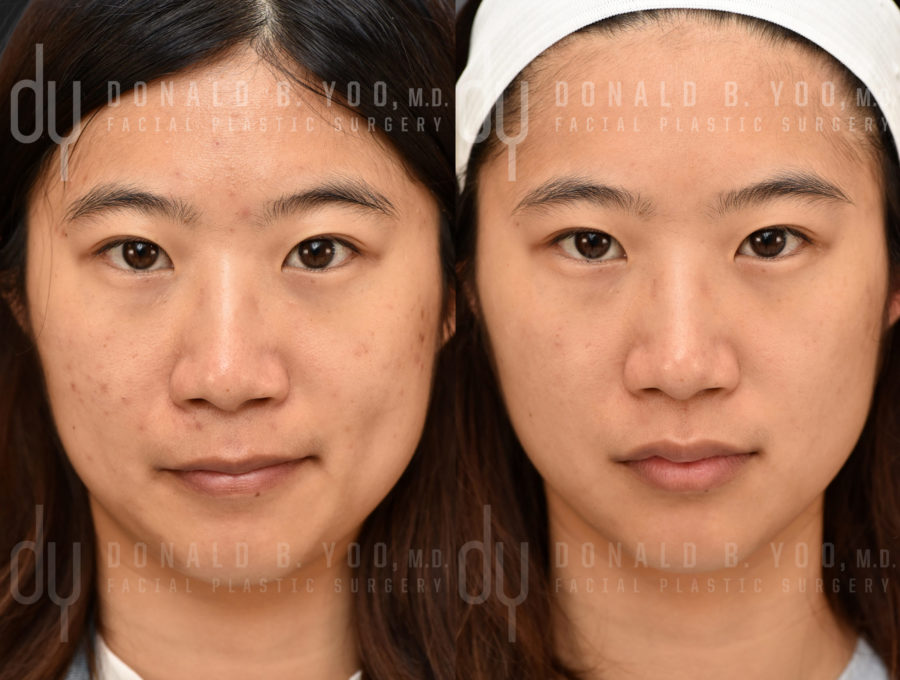 NONSURGICAL :: PICOSURE<br>Picosure for acne scars and hyper pigmentation