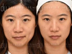 NONSURGICAL :: PICOSURE<br>Picosure for acne scars and hyper pigmentation