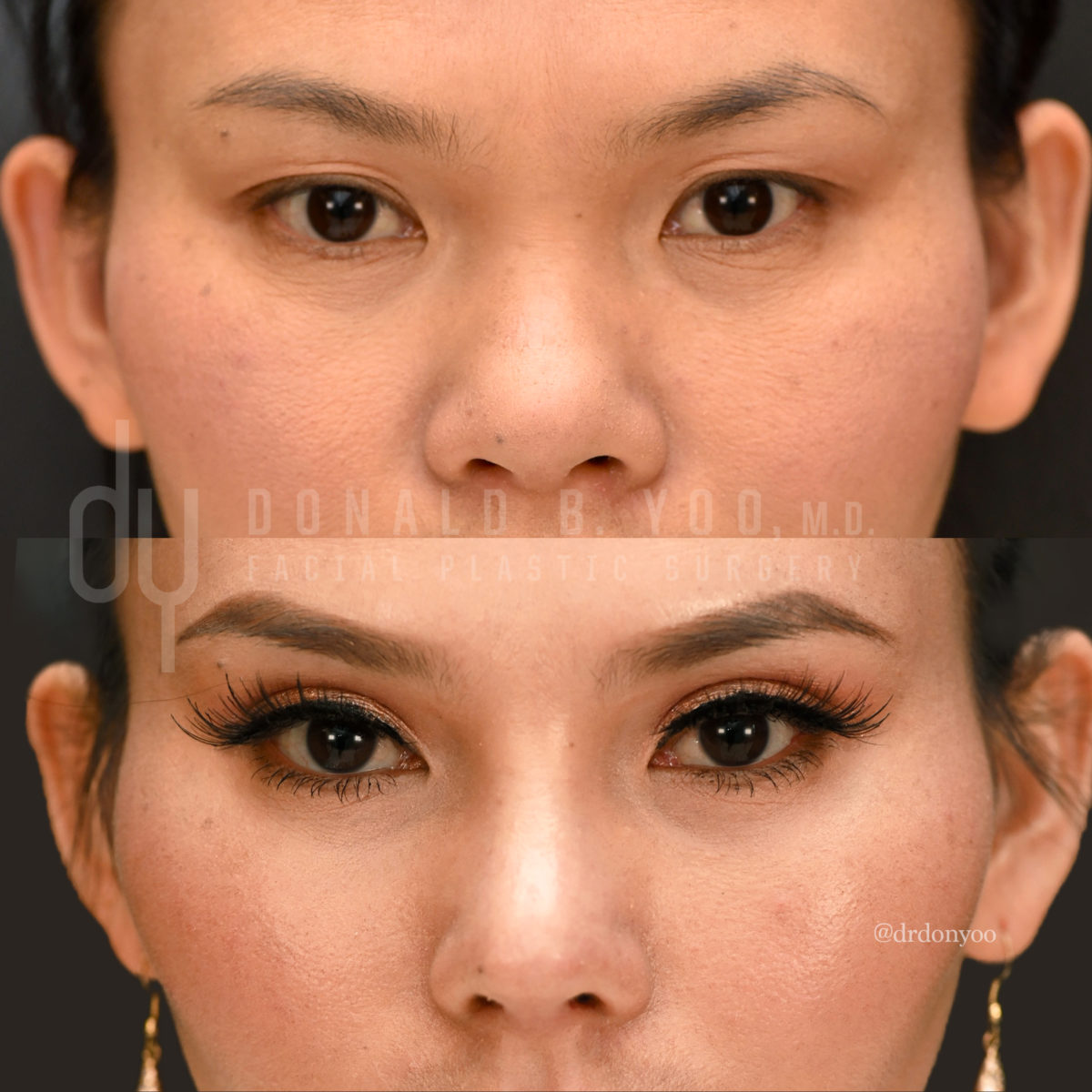 SURGICAL :: BLEPHAROPLASTY<br>Upper Blepharoplasty