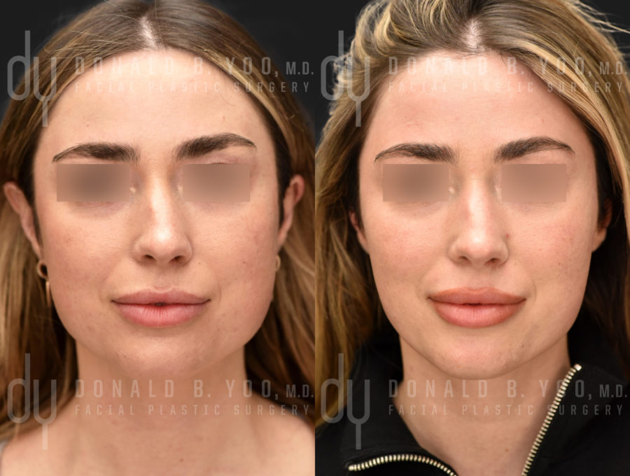 NONSURGICAL :: BOTOX<br>V-line Masseter Reduction