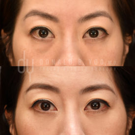 SURGICAL :: BLEPHAROPLASTY<br>Lower Blepharoplasty with Fat Repositioning