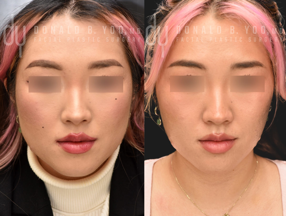 NONSURGICAL :: BOTOX<br>V-line Masseter Reduction