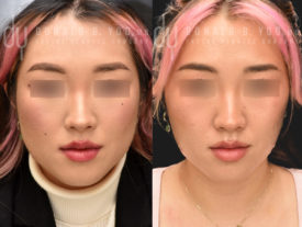 NONSURGICAL :: BOTOX<br>V-line Masseter Reduction