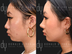 SURGICAL :: RHINOPLASTY<br>Rhinoplasty and Chin Augmentation